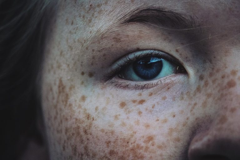 Moles and Abnormal Freckles: How to Check for Signs of Skin Cancer
